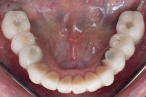 Implants and Teeth Mixed- Full Mouth Rehabilitation after