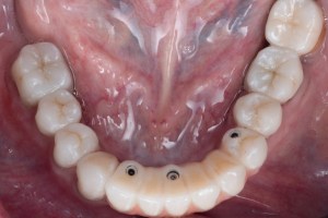 Deep Overbite- After Full Mouth Rehabilitation