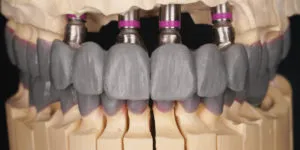 Full mouth mold of Full Mouth Rehabilitation