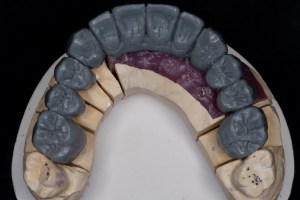 Mold of a overbite- bottom teeth