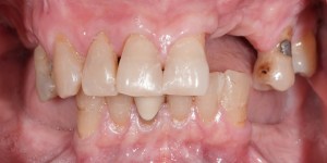 Full mount rehabilitation missing teeth before